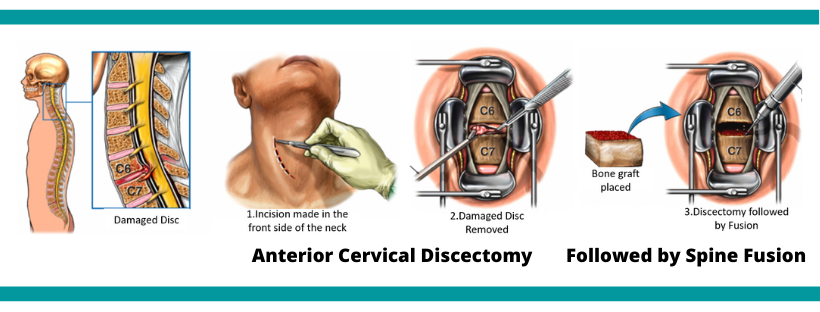 Anterior Cervical Discectomy And Fusion Acdf Surgery In Mumbai Dr